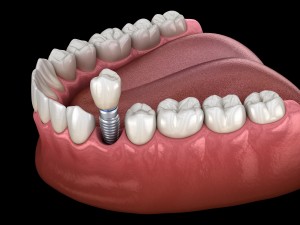 Premolar tooth recovery with implant. Medically accurate 3D illustration of human teeth and dentures concept