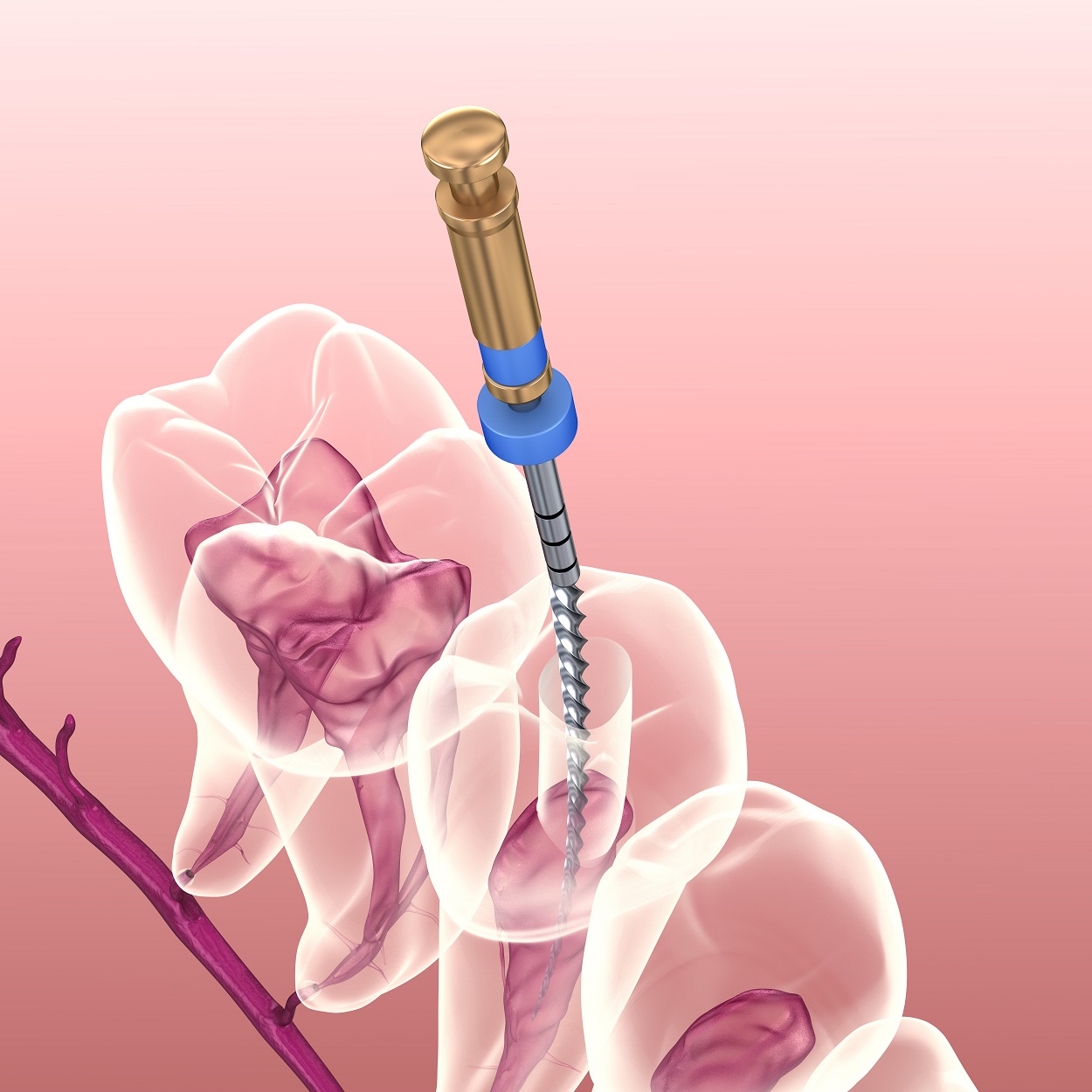 Endodontic root canal treatment process. Medically accurate tooth 3D illustration.