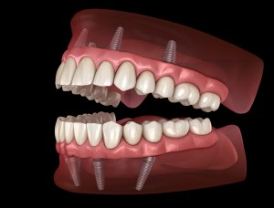 Maxillary and Mandibular prosthesis with gum All on 4 system supported by implants. Medically accurate 3D illustration of human teeth and dentures