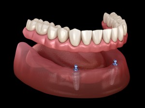 Mandibular removable prosthesis All on 2 system supported by implants with ball attachments. Medically accurate dental 3D illustration