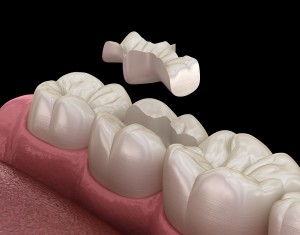 Inlay ceramic crown fixation over tooth. Medically accurate 3D illustration of human teeth treatment