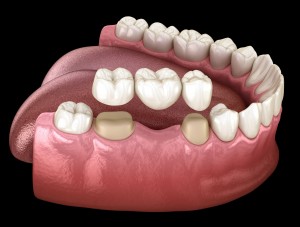 Dental bridge of 3 teeth over molar and premolar. Medically accurate 3D illustration of human teeth treatment