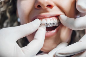 Doctor putting a clear dental aligner to the patient woman