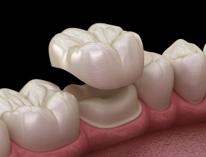 Preparated molar tooth for dental crown placement. Medically accurate 3D illustration